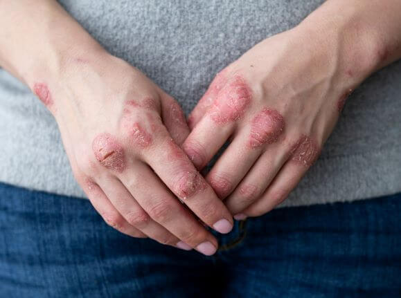 Psoriasis on hands during COVID-19 pandemic
