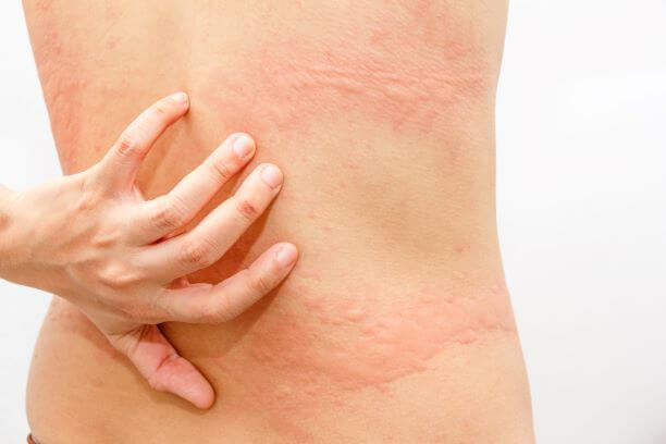 Hives on a woman's back