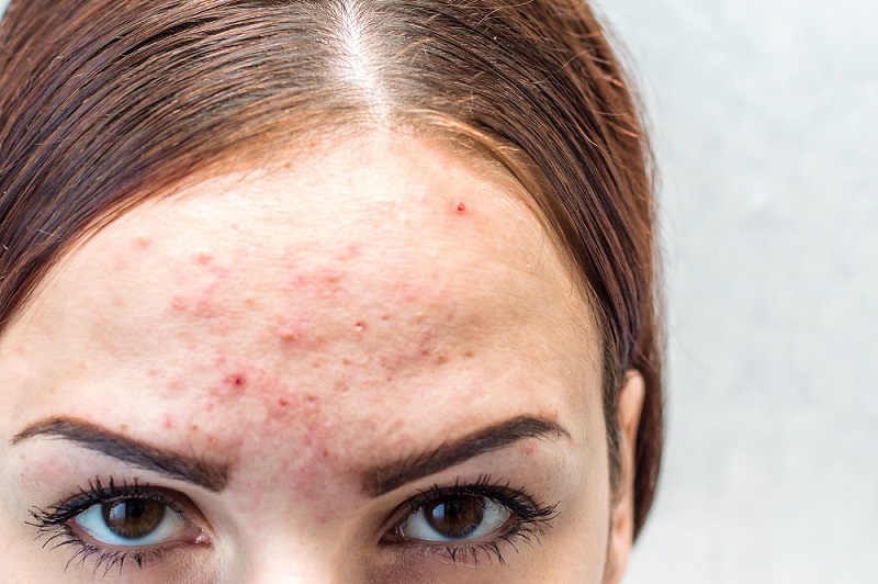 If you’ve struggled with moderate to severe acne, including cystic or nodular acne, you know that many common acne treatments aren’t effective for everyone. Fortunately, the physicians at U.S. Dermatology Partners commonly prescribe Accutane (isotretinoin) for the treatment of those patients with acne that is unresponsive to other therapeutic options.