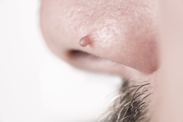 Skin tags on nose