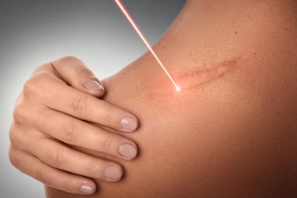 Scar revision treatment with laser