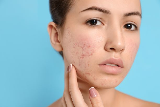 Woman with acne taking Accutane