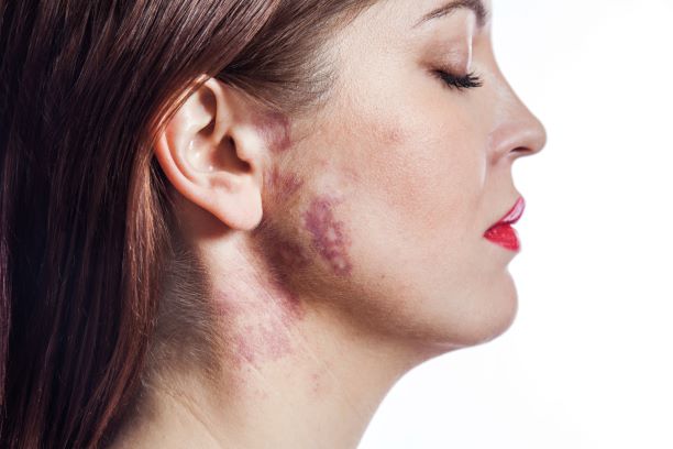 Woman with port wine stain birthmark on cheek