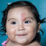 Understanding Birthmarks & Treatment Options