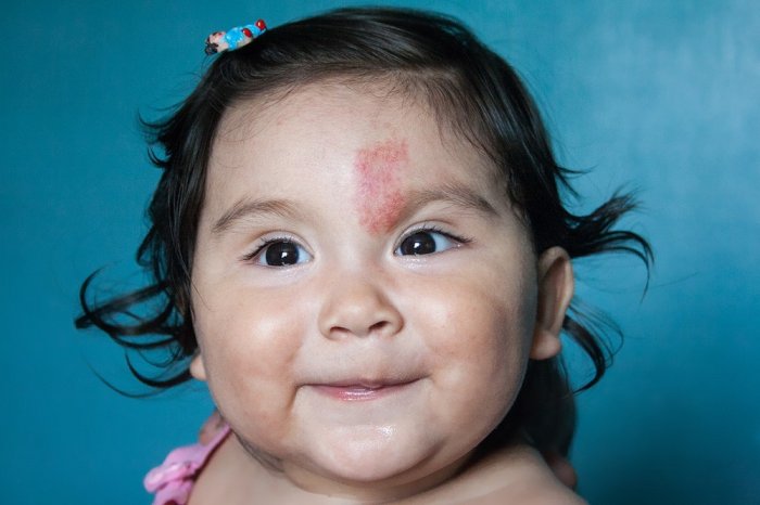 Understanding Birthmarks & Treatment Options