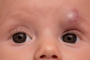 Deep hemangiomas – as the name suggests, this type of hemangioma develops deep into the skin. Color varies, but most people have skin-colored or blue-purple hued deep hemangiomas. Like strawberry hemangiomas, deep hemangiomas may also break down and cause discomfort. If the hemangioma is painful or it bleeds, take your child to see a dermatologist. This type of birthmark is typically gone by the age of ten.