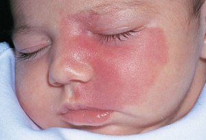 Port-wine stains – these birthmarks are small spots or larger patches that are a shade of pink, red, or purple, mimicking the appearance of spilled red wine, which is why they are called port-wine stains. The birthmark will grow with your child, and the color and texture of the birthmark may change. For most people, port-wine stains are permanent.