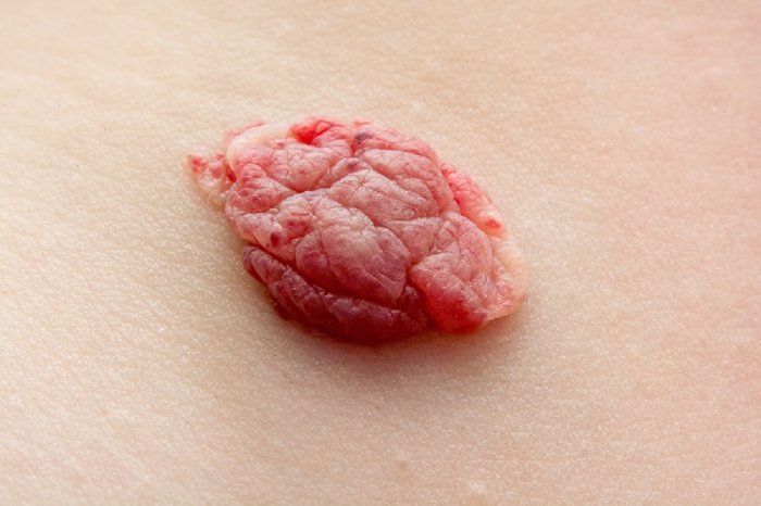 Strawberry hemangiomas may look like a pink or red (strawberry-colored) lump. Typically, this type of birthmark protrudes from the skin and feels rubbery, but they may also develop below the skin. These birthmarks will grow for several months or longer, but eventually, the strawberry hemangioma will get smaller, softer, and lighter in color. As they grow, the hemangioma may break down and become painful, so make sure to visit a dermatologist who can help you with a treatment plan that improves comfort and diminishes healing time.