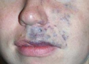 Venous malformations – when veins are enlarged or tangled, a child may develop a birthmark that appears like a blue or purple spot on the skin. These spots may get larger during activity as the blood flows. This type of birthmark is indicative of a more serious problem, and it will need to be treated with sclerotherapy or surgery to improve circulation and decrease discomfort.