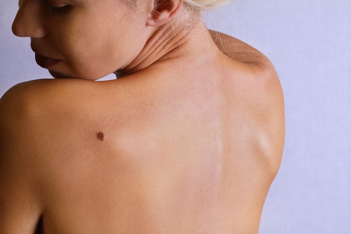 Birthmarks, as the name describes, are areas of discoloration (marks) that appear on or under the skin when a baby is born or that develop shortly after delivery. Birthmarks can develop in a variety of colors, shapes, and locations.