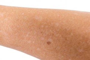 White spots – this type of birthmark develops when an area of skin has less pigmentation (color) than the natural skin tone. These birthmarks can be flat or raised off the skin’s surface. Most disappear in time as the baby grows and the skin tone evens out.