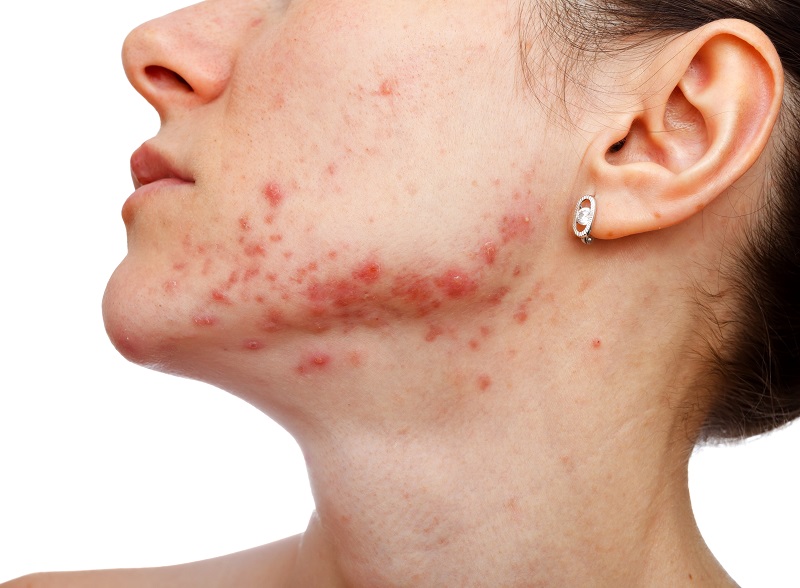 Accutane (isotretinoin) may be used to treat other skin conditions, including hidradenitis suppurativa (acne inversa), rosacea, sebaceous hyperplasia, lamellar ichthyosis, and gram-negative folliculitis.