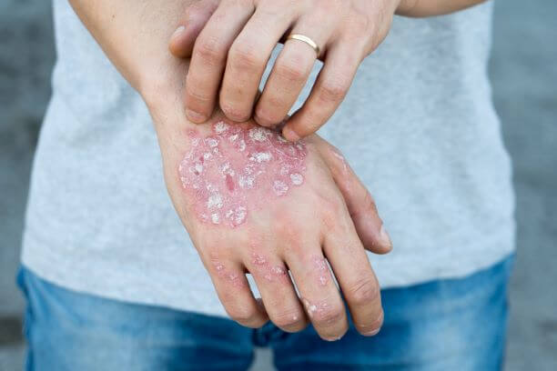 Hand with psoriasis