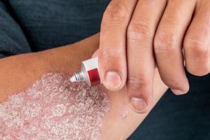 Man using topical cream to treat psoriasis