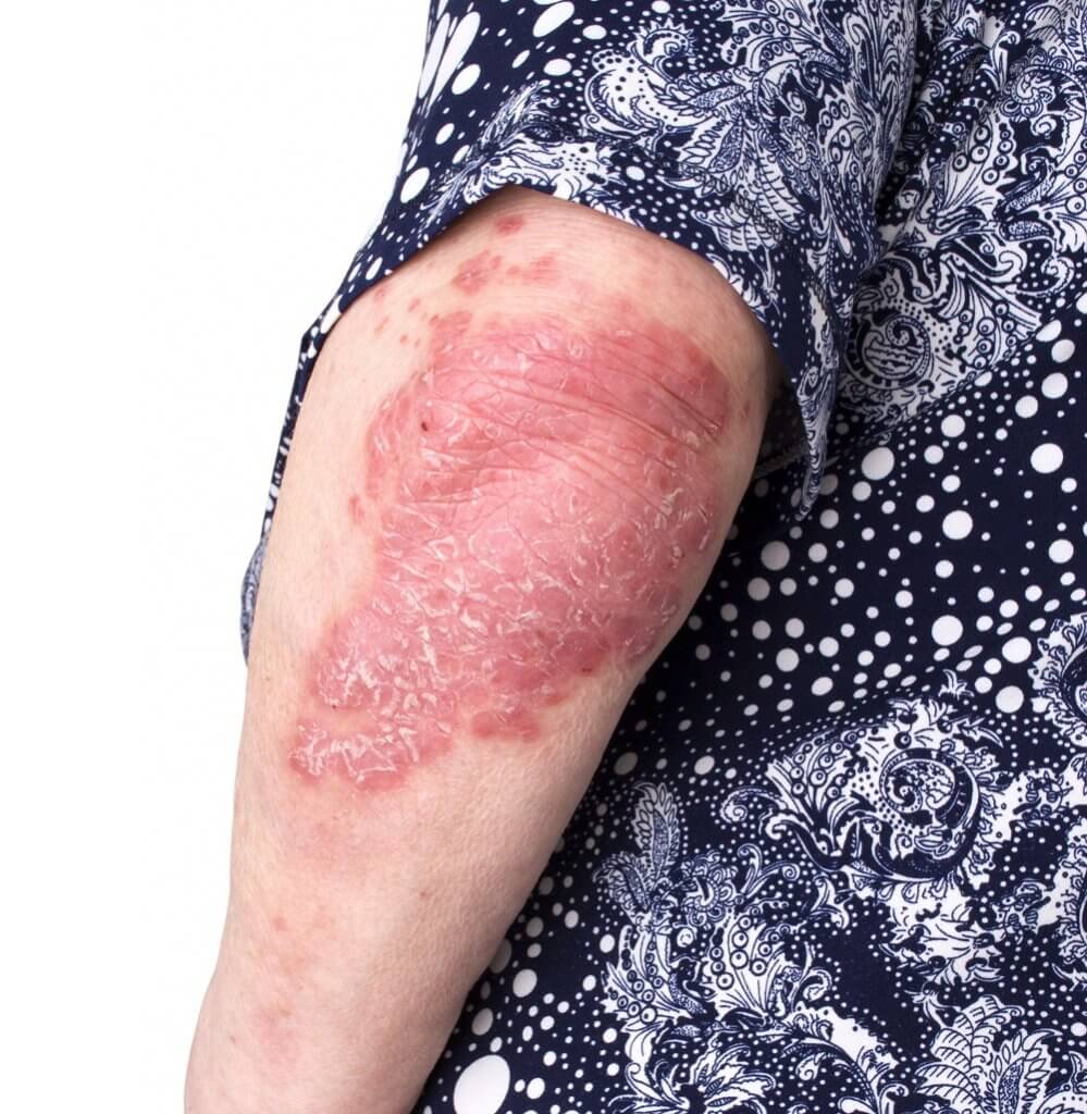 Recognizing Psoriasis