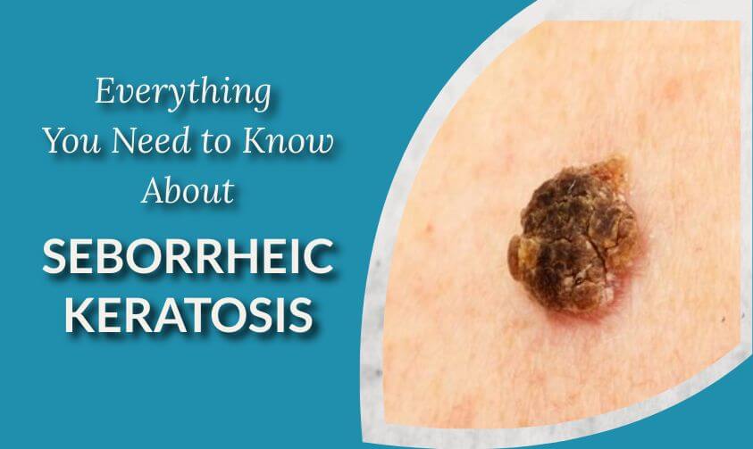 seborreic keratosis on patient's skin
