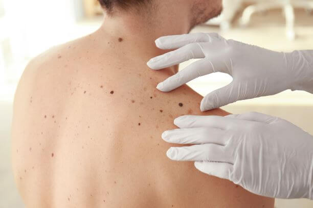 Dermatologist checking skin cancer symptoms