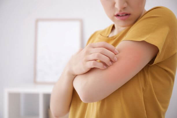 Woman scratching eczema on arm