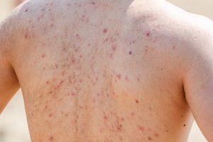 Woman wonders how to get rid of bacne