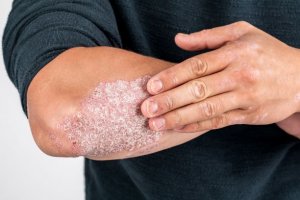 Man needs biologics for psoriasis on arm