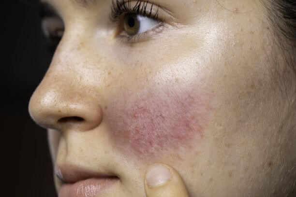 Woman with one of four types of rosacea