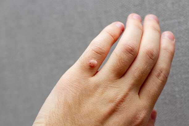 Wart on man's finger