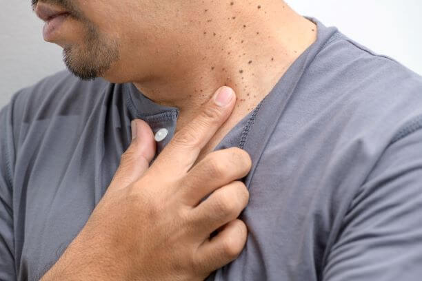 Man with skin tags on neck