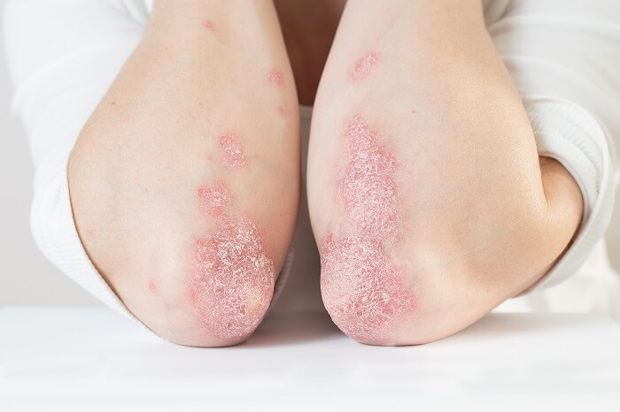 Psoriasis Clinical Trials