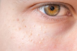 Milia is a skin condition that causes very small white or yellow-colored cysts to appear in clusters, usually on the eyelids, nose, cheeks, and chin.