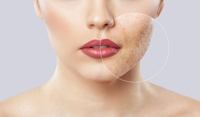 Woman who has had IPL Treatment for acne scars
