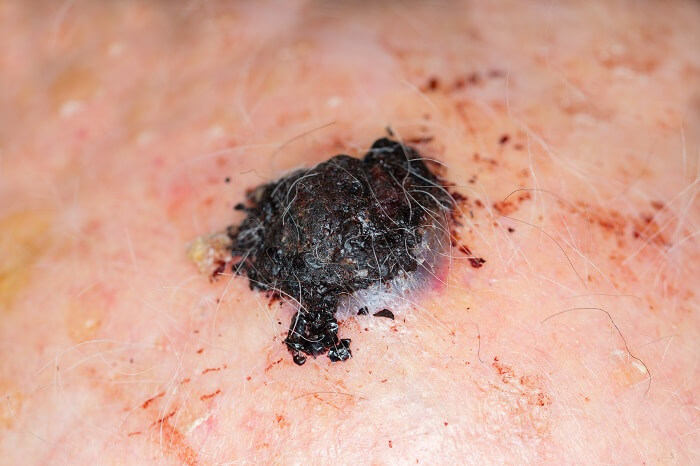 wart on scalp