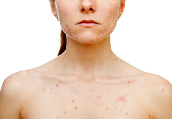 How to Get Rid of Hormonal Body Acne on the Back, Chest