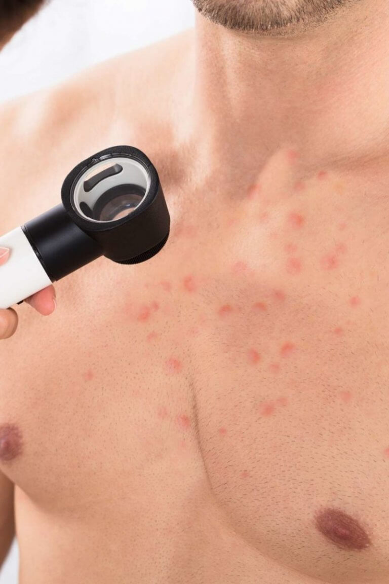 How to Get Rid of Chest Acne U.S. Dermatology Partners