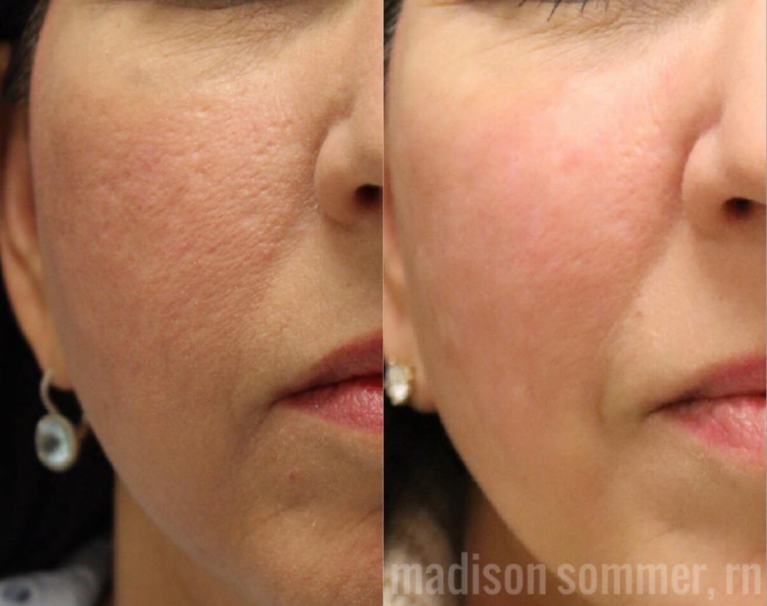 Before and After photos of Fractional RF with Pixel8 Skin Tightening 
