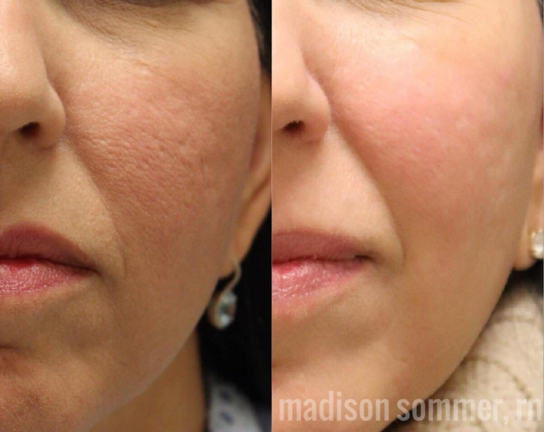 Before and After photos of Fractional RF with Pixel8 Skin Tightening treatment