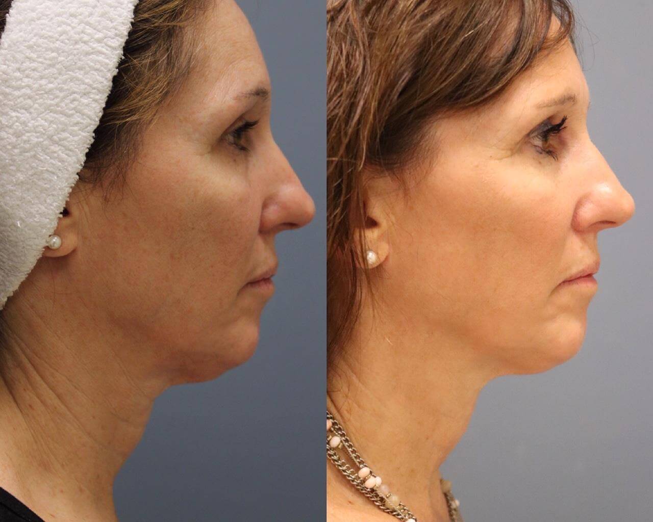 Before and after photos of Fractional RF with Pixel8 Skin Tightening treatment