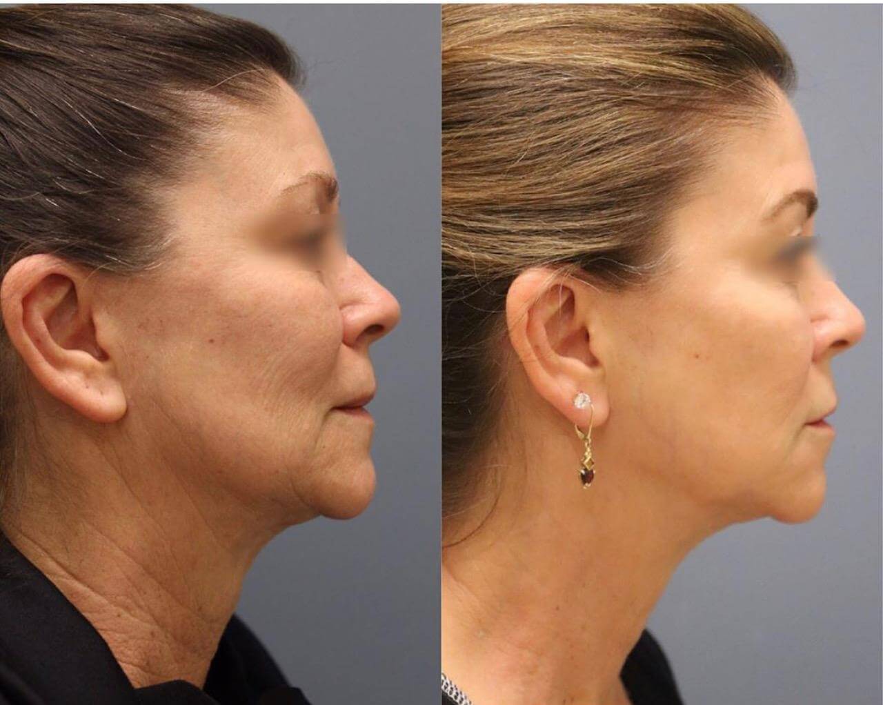 Before and after photos of Fractional RF with Pixel8 Skin Tightening treatment