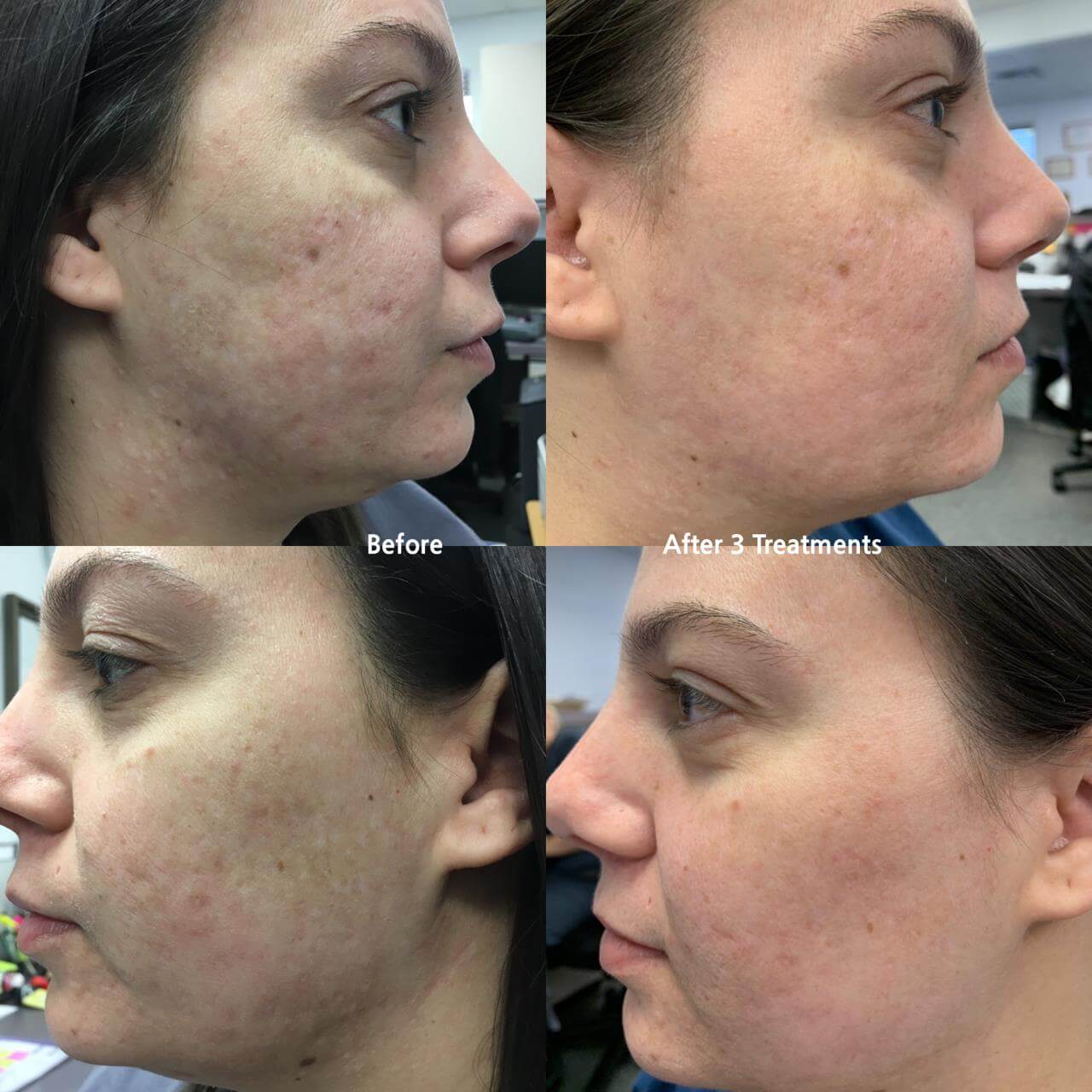 Before and After photos of Fractional RF with Pixel8 Skin Tightening treatment.