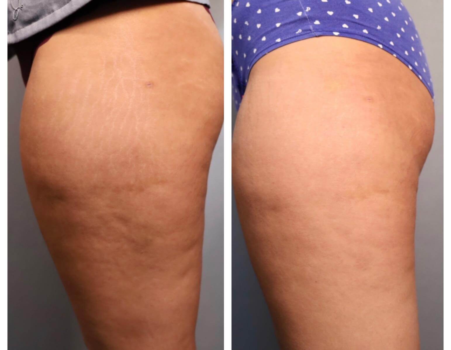 Before and After photos of Fractional RF with Pixel8 Skin Tightening treatment