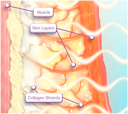 Thermage FLX | Skin Tightening