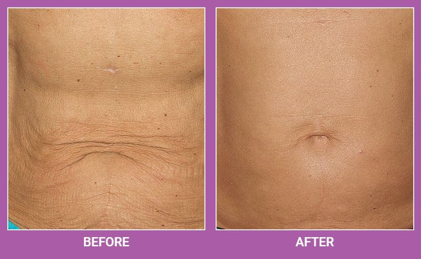 Thermage | Skin Tightening Treatment