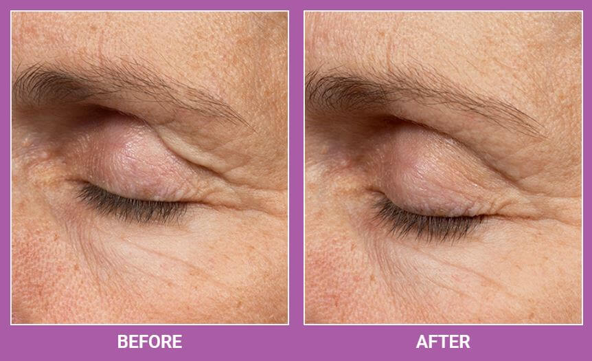 Thermage | Skin Tightening Treatment