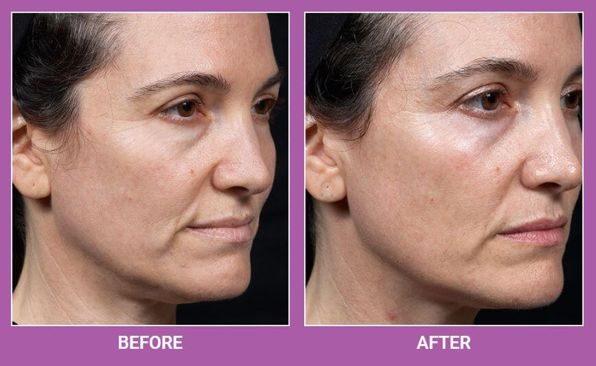 Thermage | Skin Tightening Treatment
