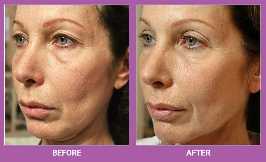 Thermage | Skin Tightening Treatment