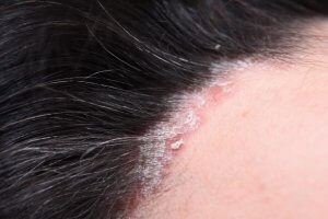 Scalp psoriasis