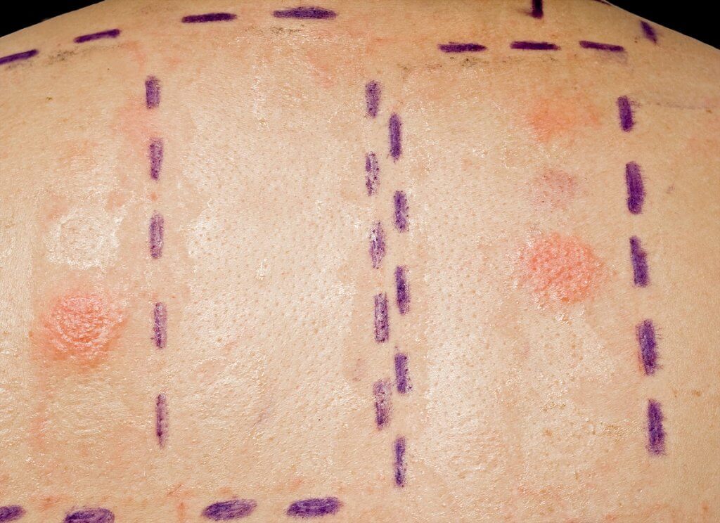 Allergy Patch Testing Treatment U S Dermatology Partners