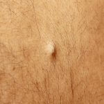 Epidermoid cysts form within hair follicles when the epidermis (outer layer of skin) grows inward toward the follicle rather than being shed away.