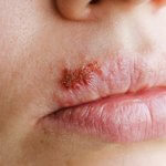 Herpes Simplex is a viral infection that is found in cold sores and fever blisters and is contagious even when sores are not visible.