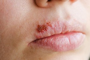 Herpes Simplex is a viral infection that is found in cold sores and fever blisters and is contagious even when sores are not visible.
