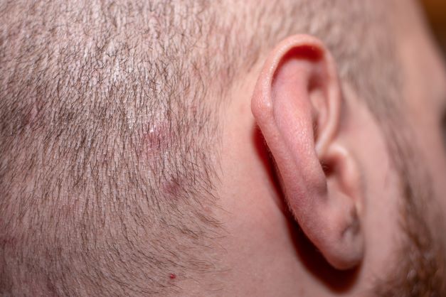 Scalp acne on man's head